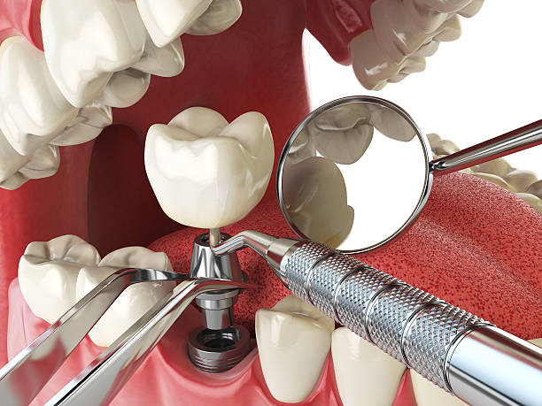 Best Emergency Treatment for Dental Infections or Abscesses in Marion, IL